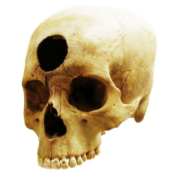 Un cráneo peruano con evidencias de trepanación de hace 2000 años. Fuente: tsaiproject. 